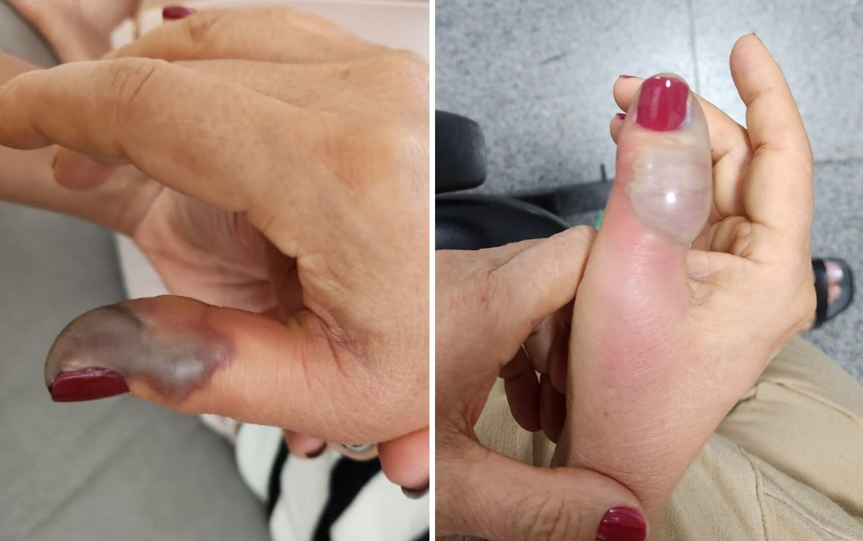 Mulher perde dedo após manicure e infecção