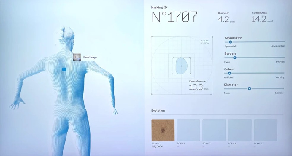 Uma das pintas que foram sinalizadas por dermatologistas na Suécia como necessitando de atenção especial. — Foto: NEKO