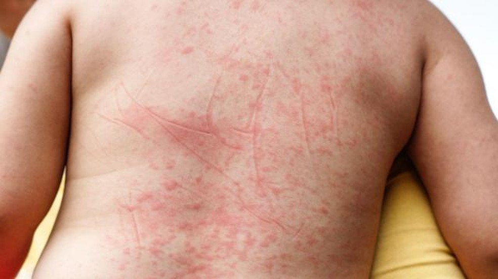 O aparecimento de manchas vermelhas na pele é um sintoma associado à febre hemorrágica da dengue — Foto: Getty Images/BBC