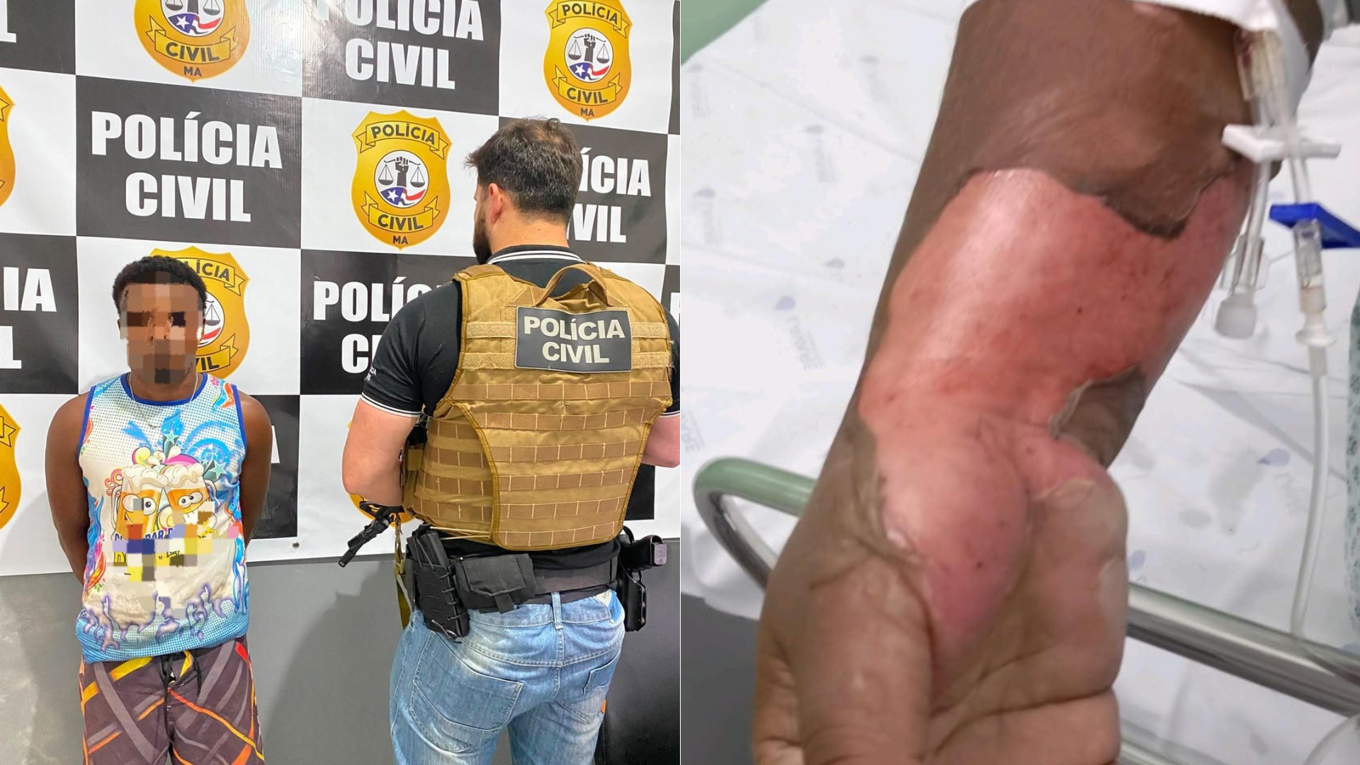 Homem é preso suspeito de atear fogo na ex-companheira em tentativa de feminicídio no MA