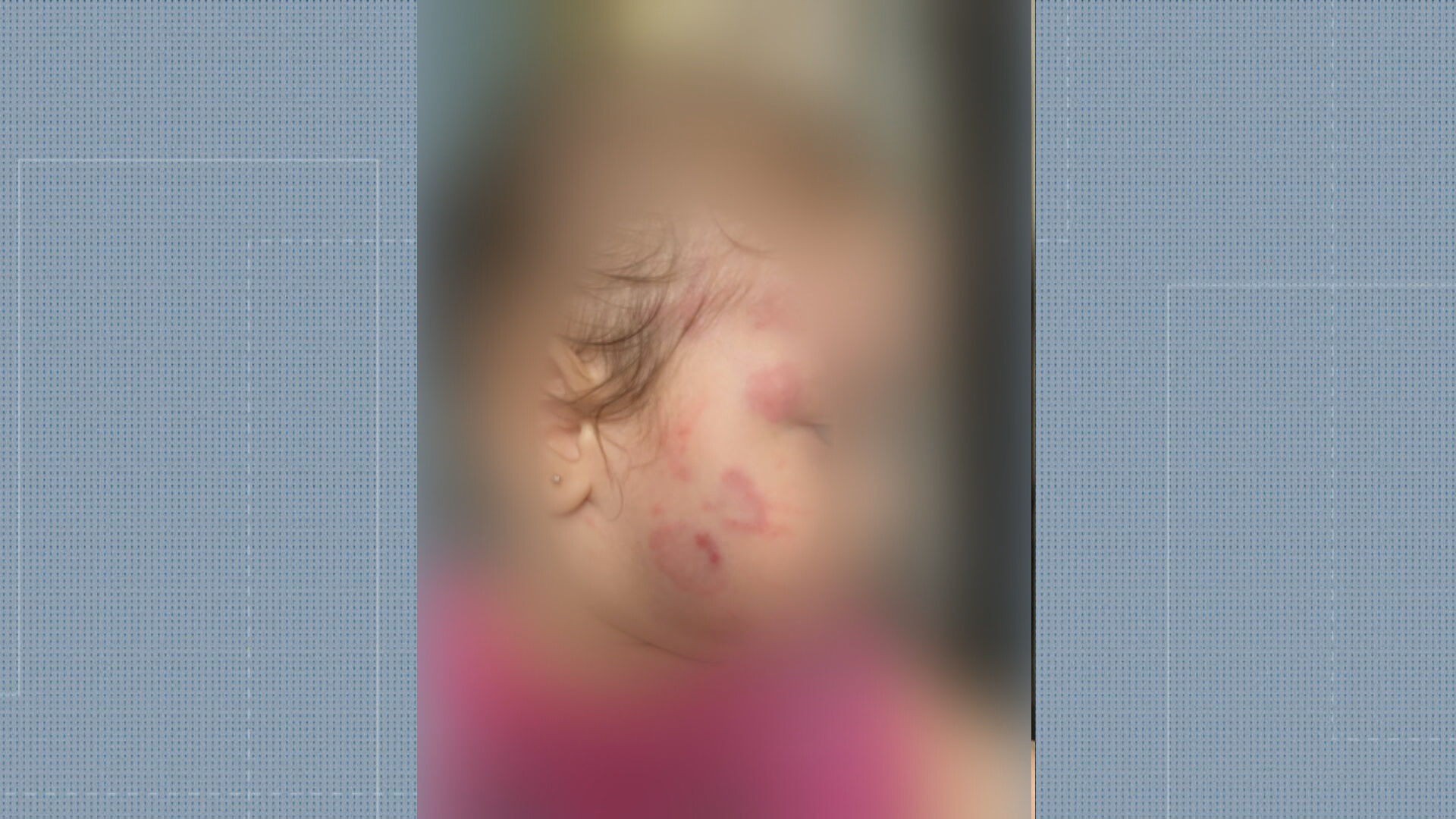 Bebê é agredida em creche, fica com vários hematomas e família alega omissão de socorro 