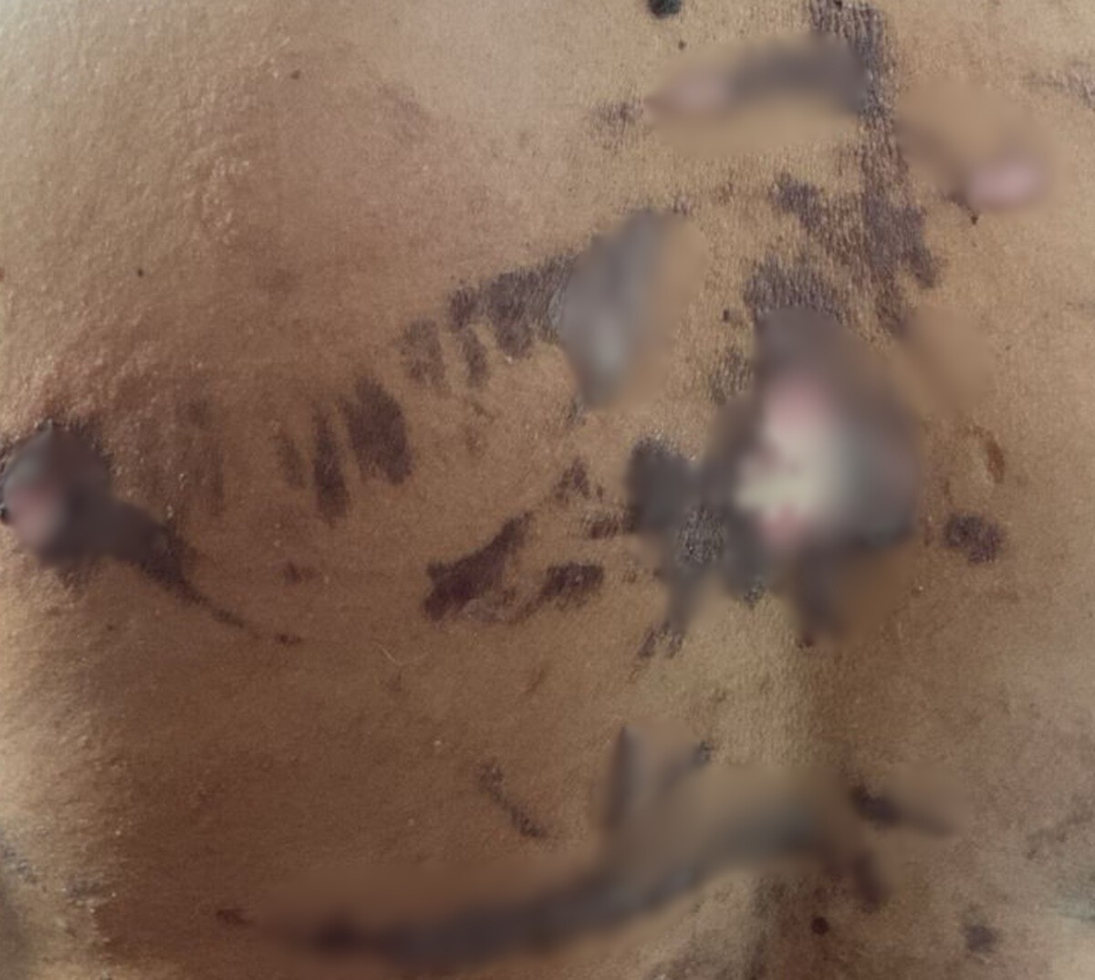 Paciente afirma que ficou sem apoio da prefeitura após relatar queimaduras em hospital de Arraial do Cabo