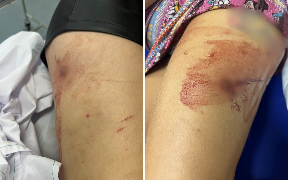 Imagens mostram feridas nas pernas de mulheres baleadas em frente a boate de Goiânia, Goiás — Foto: Reprodução/Polícia Militar