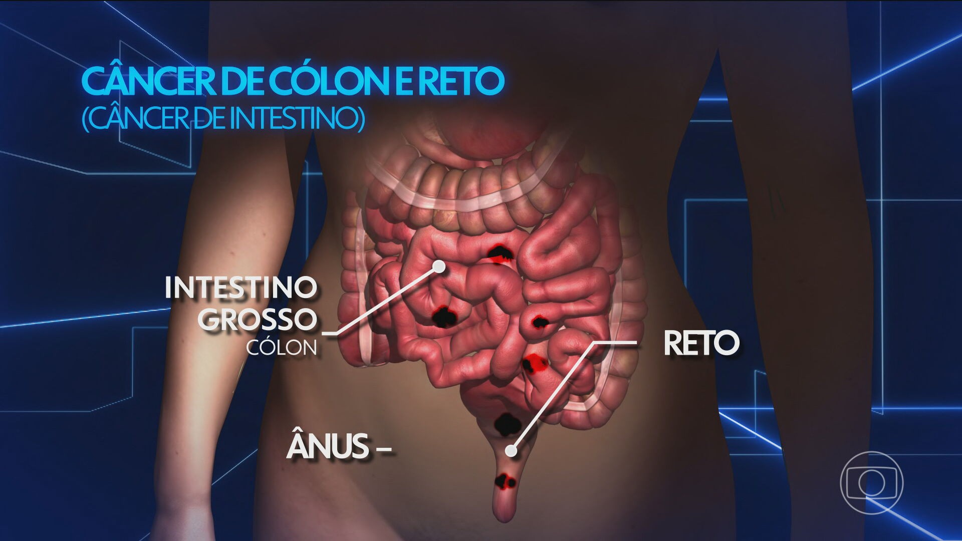 Médicos alertam para aumento de câncer colorretal entre pessoas com menos de 50 anos