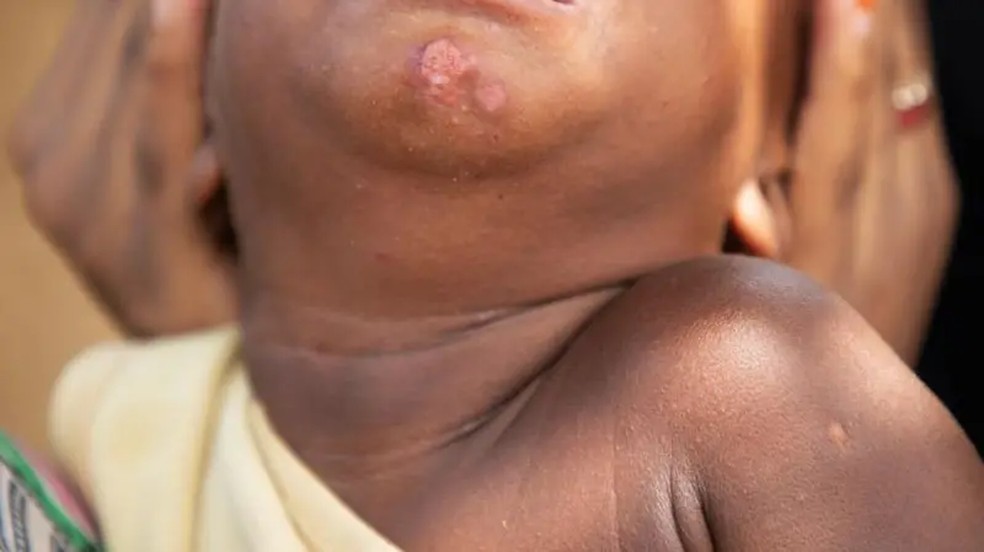 O filho pequeno de Fátima ainda tem feridas no rosto causadas por produtos clareadores de pele que estão demorando para cicatrizar — Foto: BBC