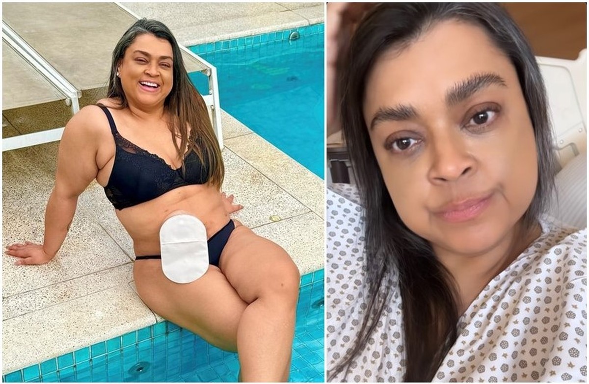 Preta Gil passa por nova cirurgia em SP para retirada de bolsa de ileostomia | São Paulo | G1