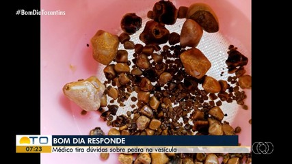Pedra na vesícula é tema de dúvidas com médico no Bom Dia Responde