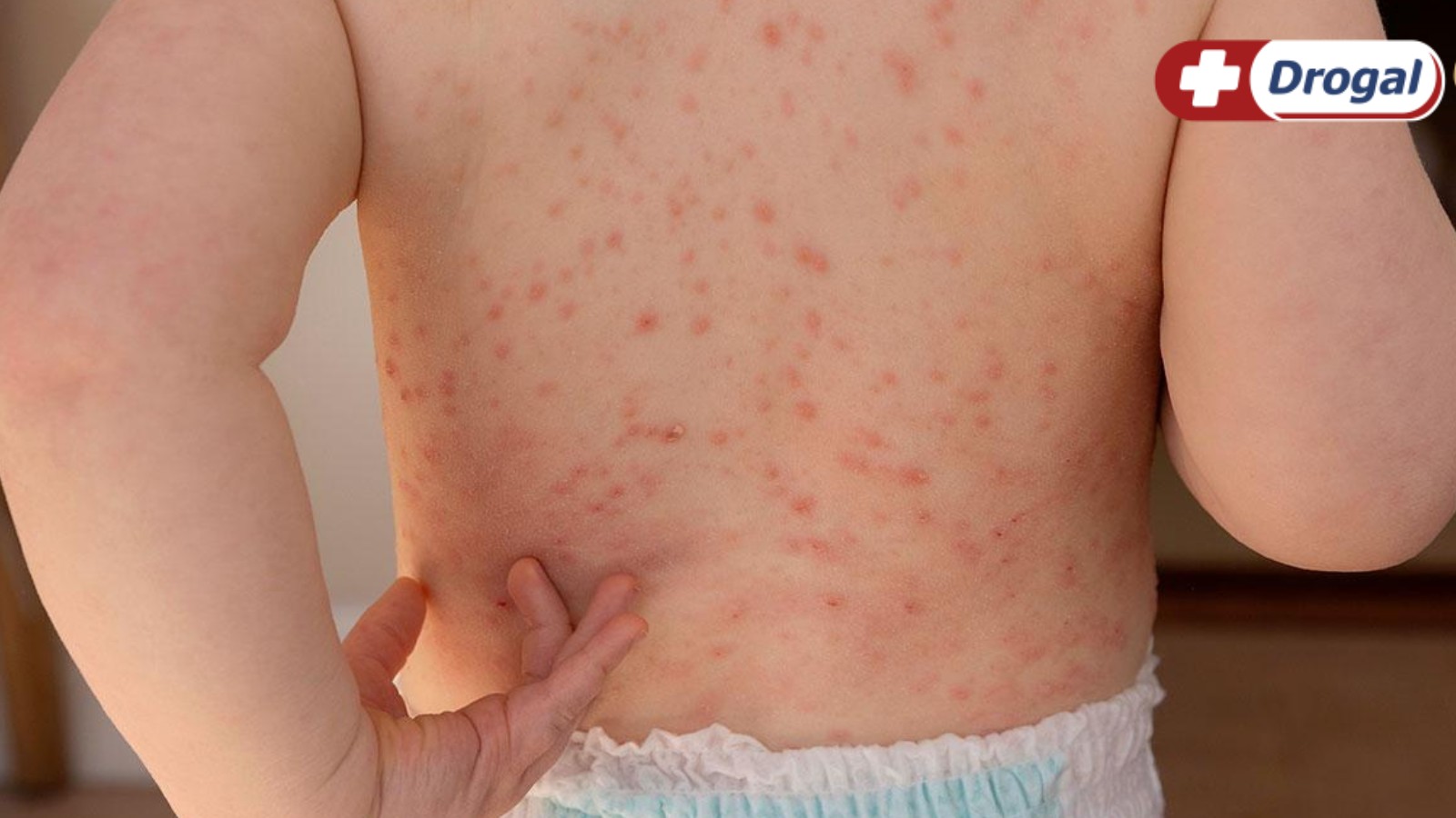 Como ocorre a transmissão do sarampo e como prevenir o contágio