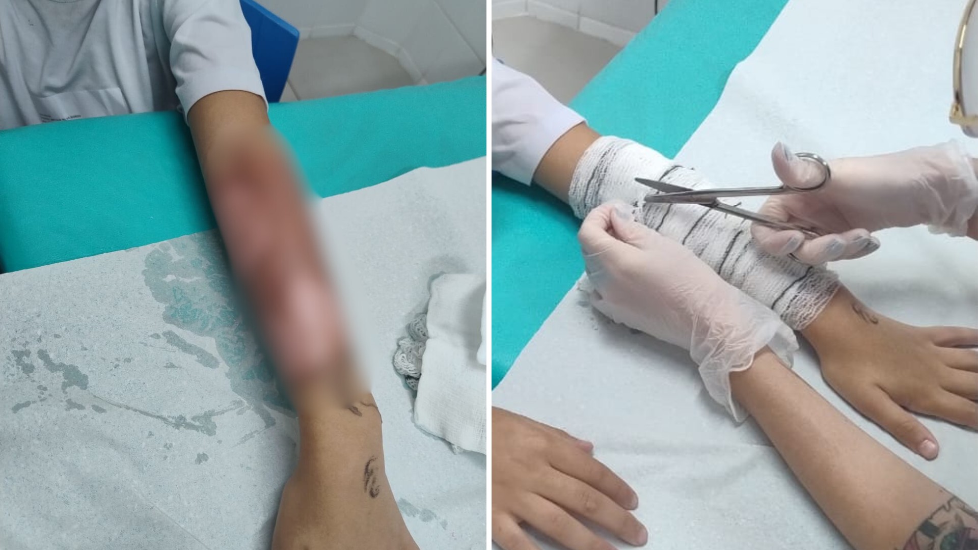 Menino tem queimadura após água quente cair no braço durante experimento em escola
