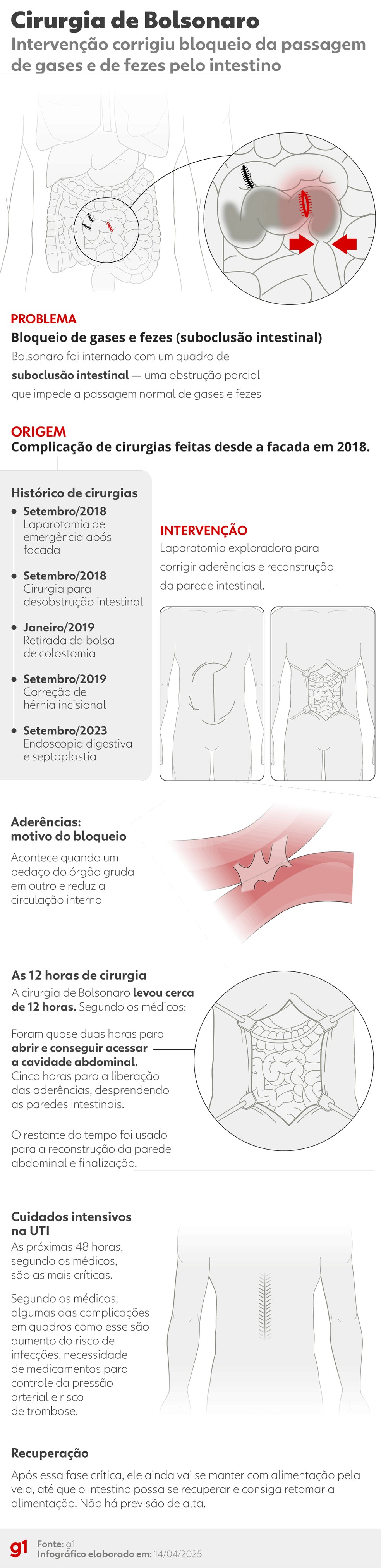 Cirurgia de Bolsonaro: entenda o procedimento — Foto: Arte/g1