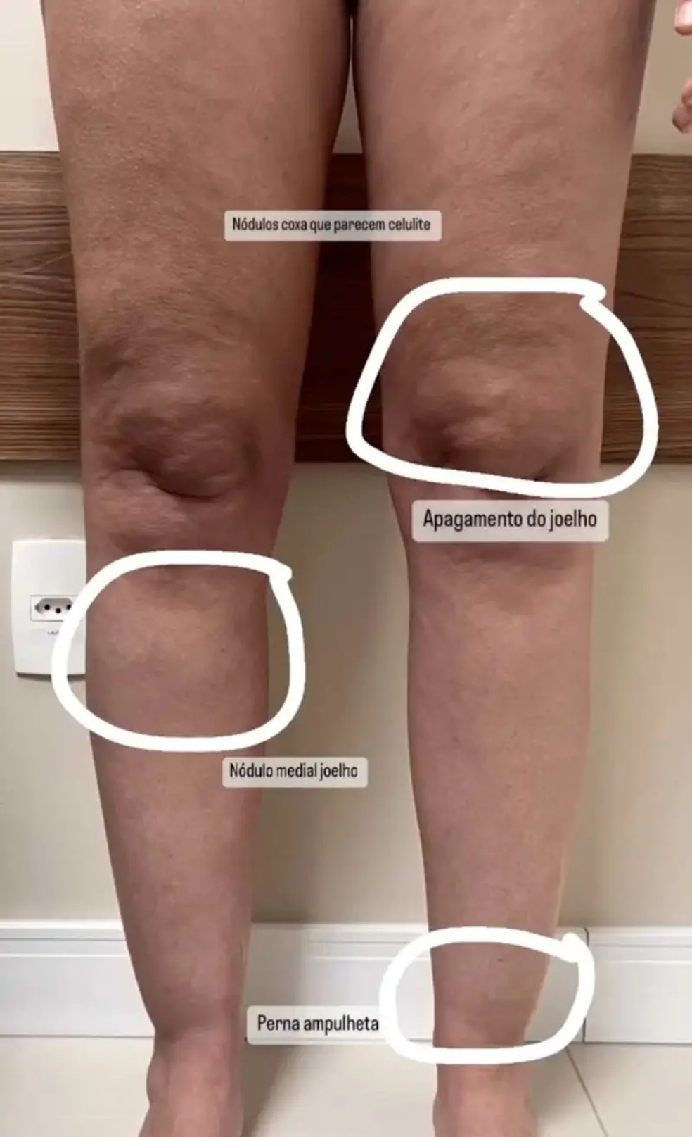 Um vídeo publicado pela médica Thais Torres, cirurgiã vascular, mostra alguns sinais visuais específicos do lipedema — Foto: Crédito: Reprodução TikTok/@leticia.melchioretto