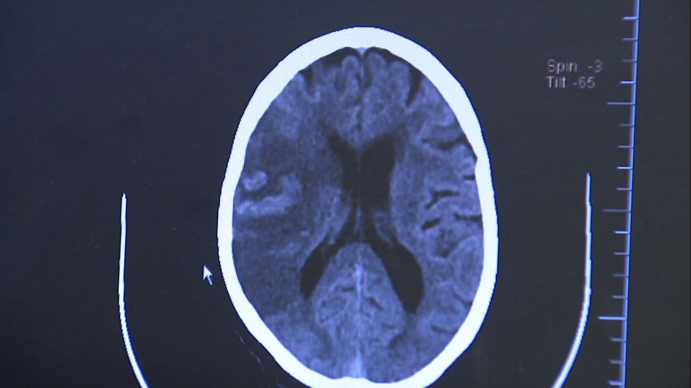 AVC tira a vida de um brasileiro a cada seis minutos