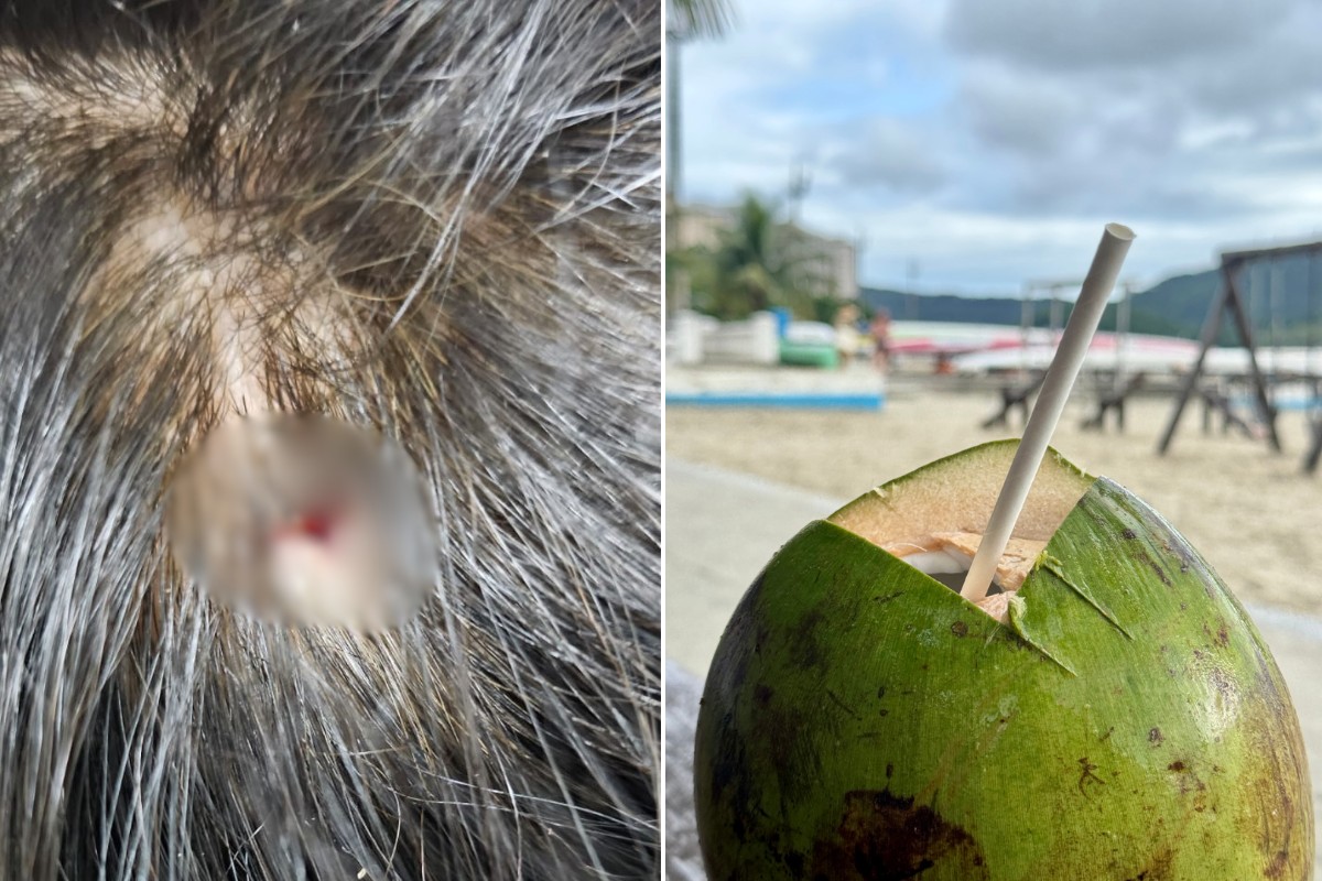 Facão quebra ao abrir coco e lasca corta cabeça de mulher na orla de Santos, SP