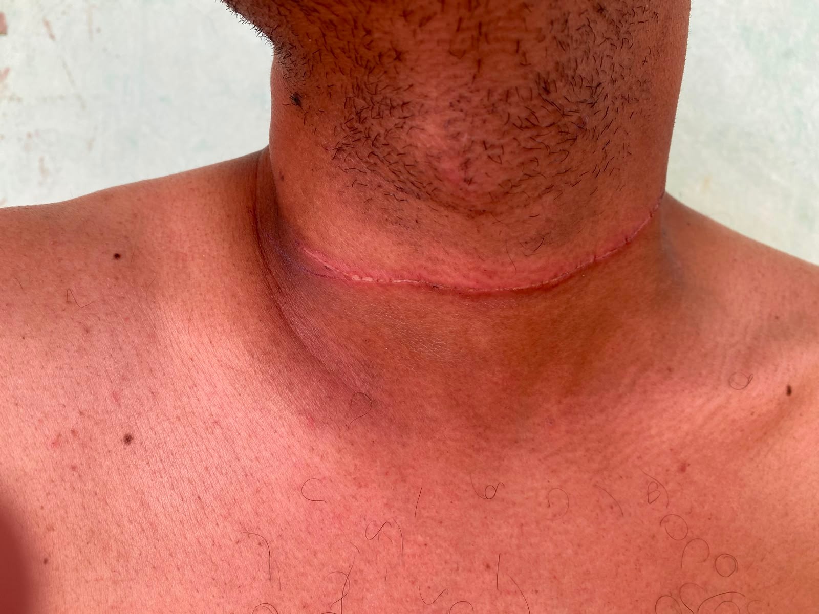 Motociclista sofre corte no pescoço por linha de cerol no Acre: 'Vi minha vida indo embora'