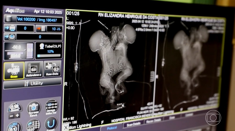 Gêmeas siamesas retornam para casa após cirurgia bem-sucedida — Foto: Reprodução Fantástico