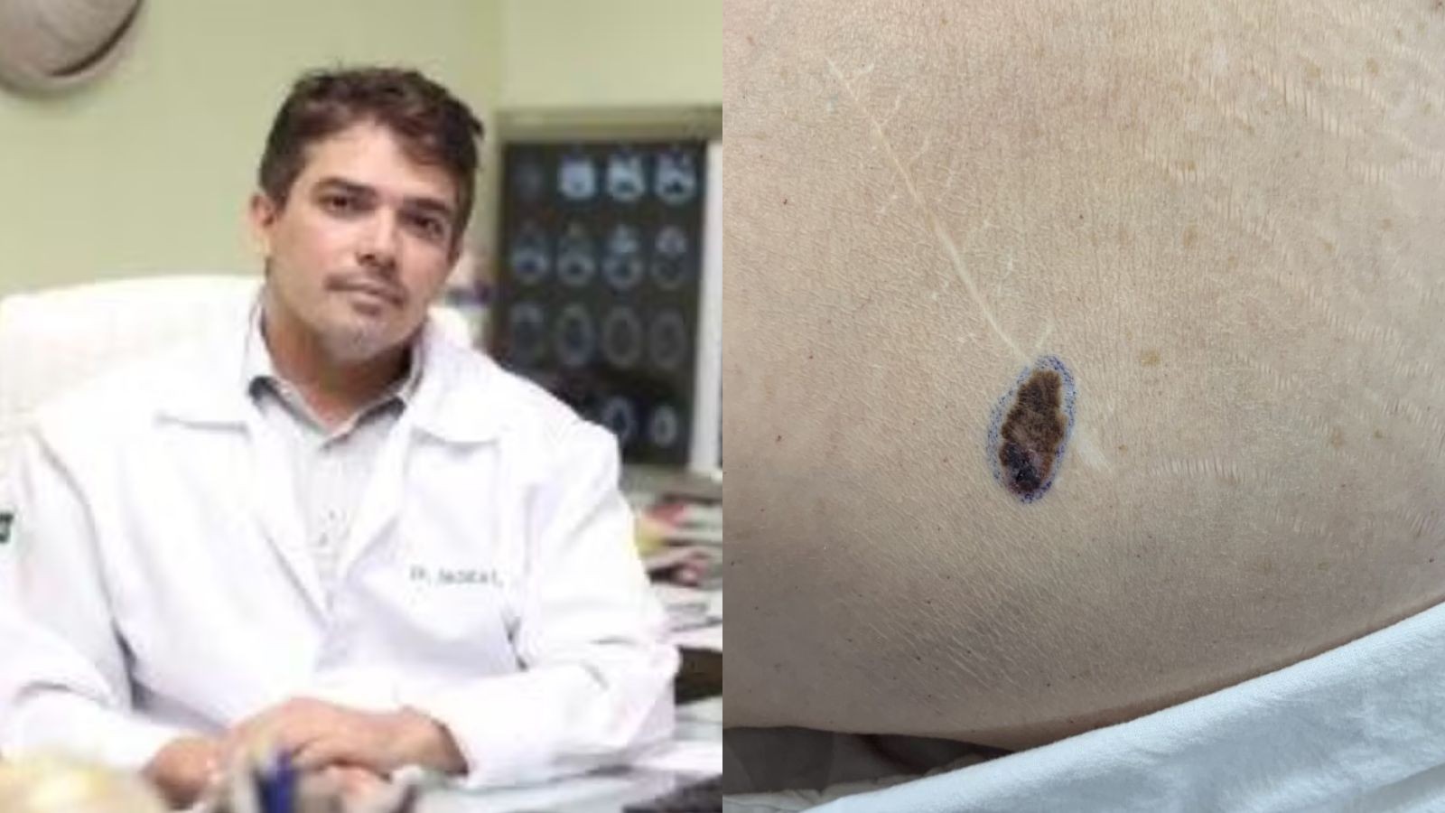 Melanoma: câncer que levou à morte do neurocirurgião Jacinto Lay é o mais agressivo entre os tumores de pele, explica especialista