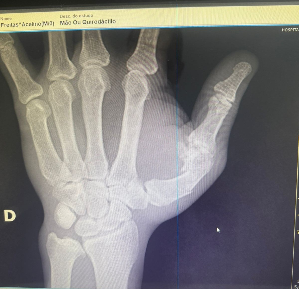 Popó passa por cirurgia após briga generalizada em luta contra Wanderlei Silva; entenda o quadro