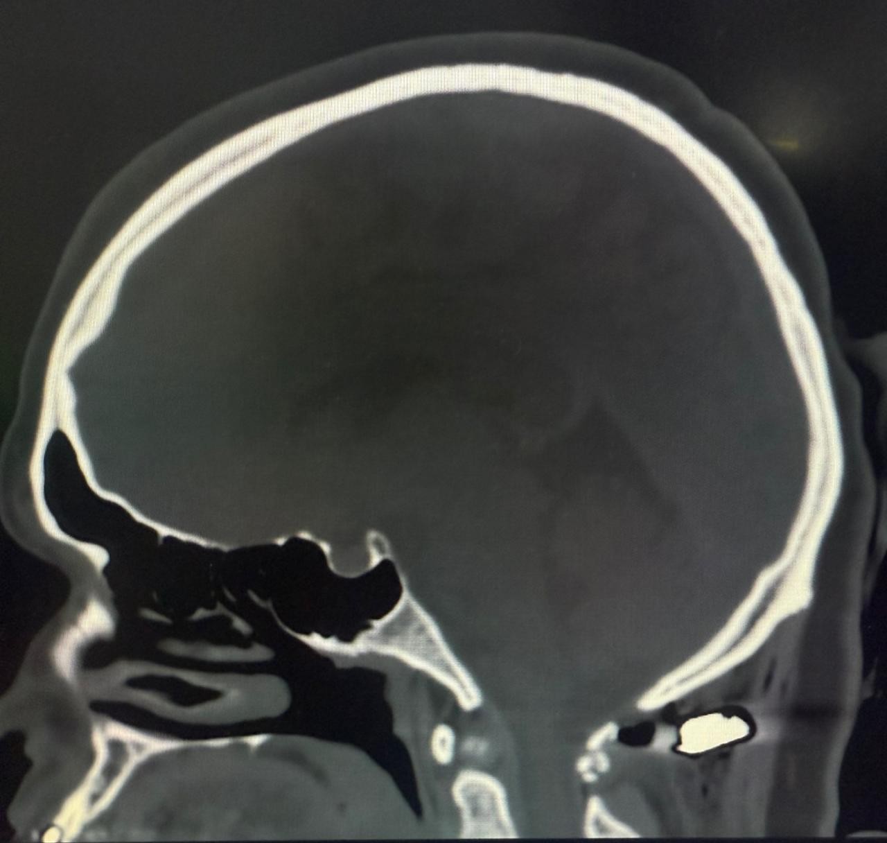 Mulher atingida por bala perdida não ficou tetraplégica por 4 milímetros, diz médico: 'Inacreditável que esteja tão bem'