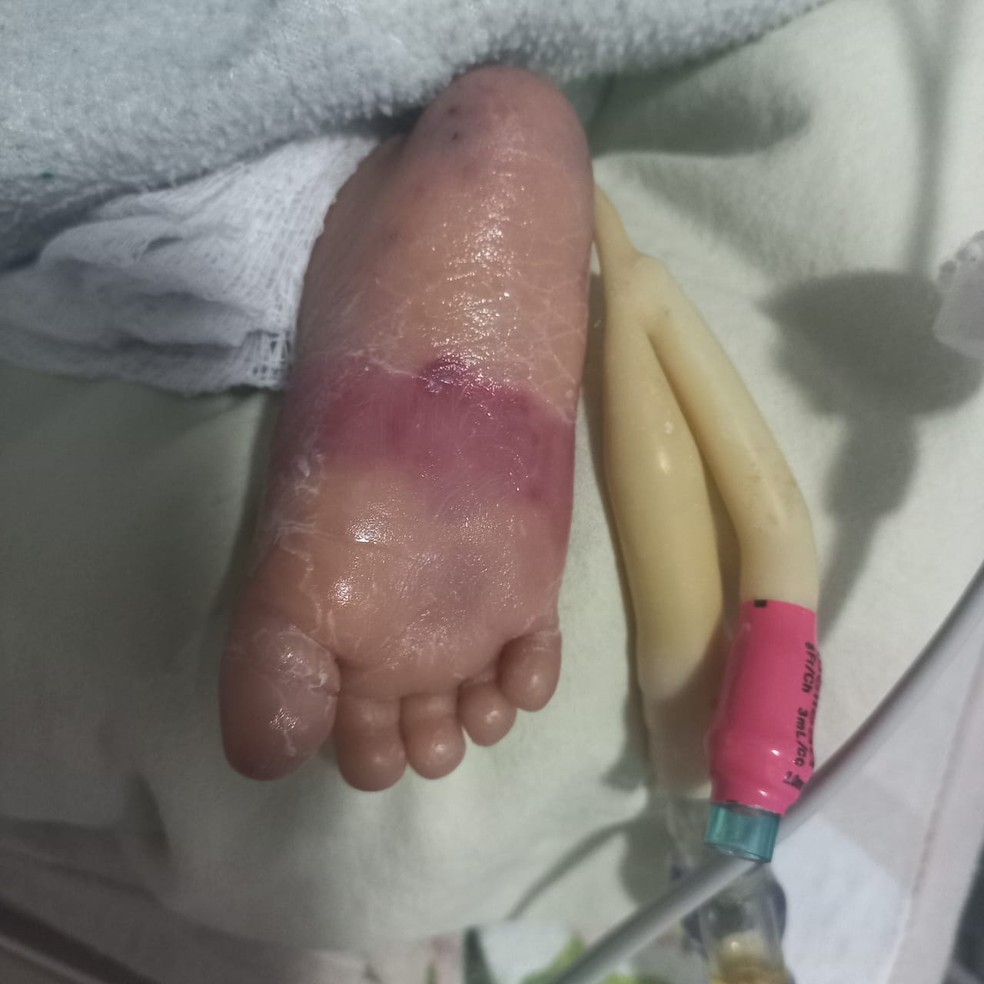 Segundo mãe, o bebê apresentou queimaduras, lesões e assaduras — Foto: Arquivo pessoal