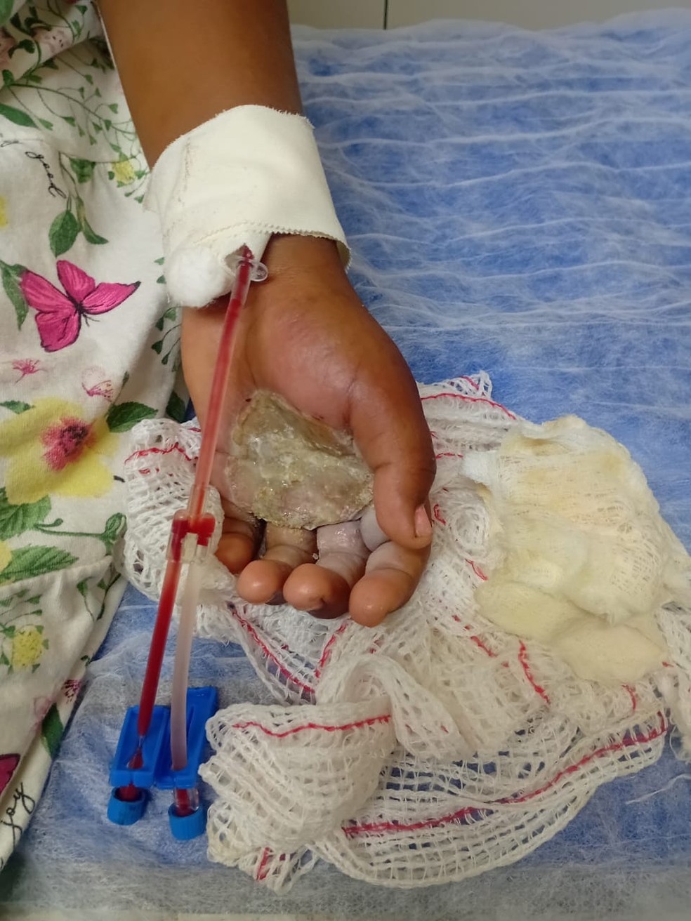 Criança de 9 anos teve queimaduras graves nas mãos após tortura e ficou internada no Hospital Estadual Alberto Torres — Foto: Reprodução