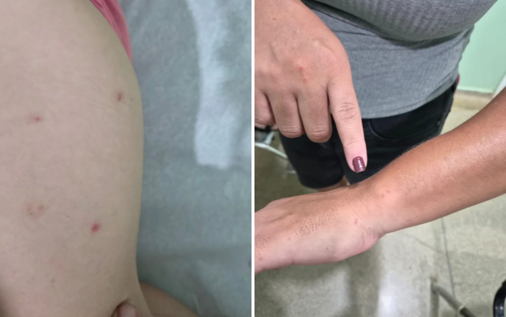 Coceiras, manchas na pele: o que indicam os sintomas apresentados por adultos e crianças em Brodowski, SP