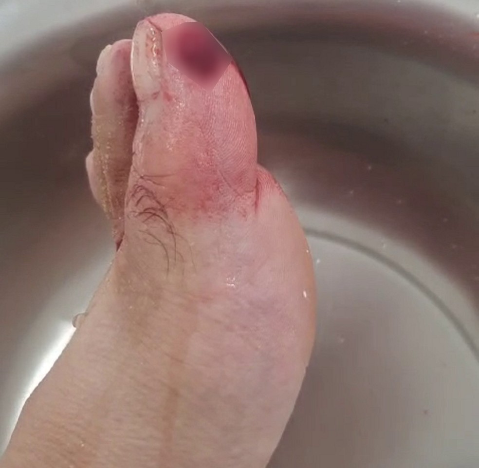 Banhista atacado por piranha precisou de atendimento médico, em Rosana (SP) — Foto: Cristiano Oliveira de Carvalho