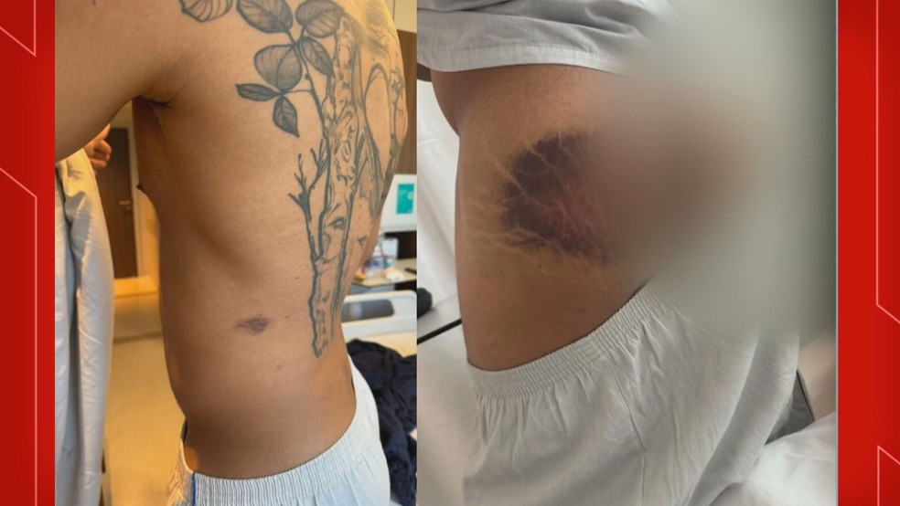 Imagem mostra hematomas no corpo do soldado Danilo — Foto: Reprodução