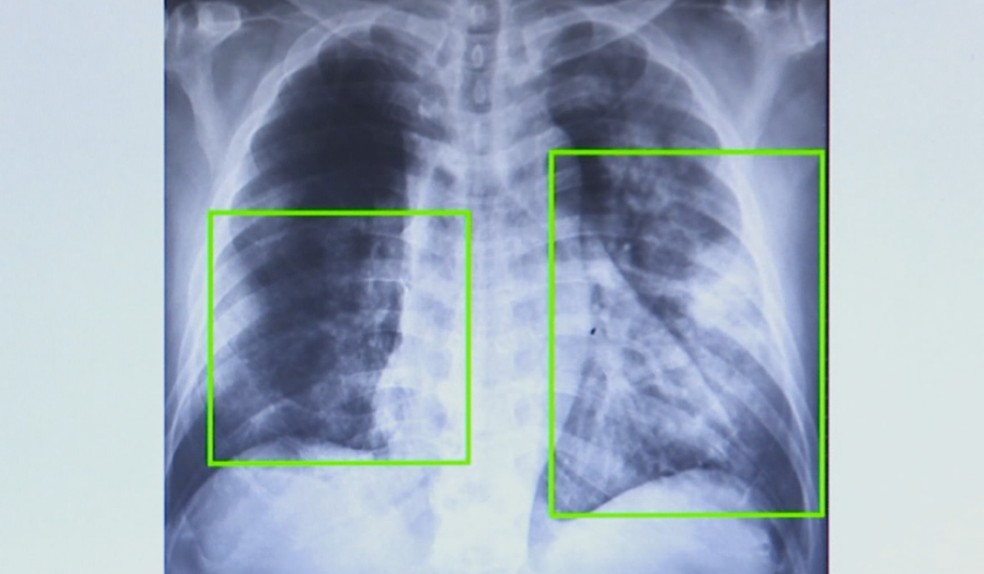 Atendimentos por pneumonia quase dobram em 7 meses na região de Campinas. — Foto: Reprodução EPTV