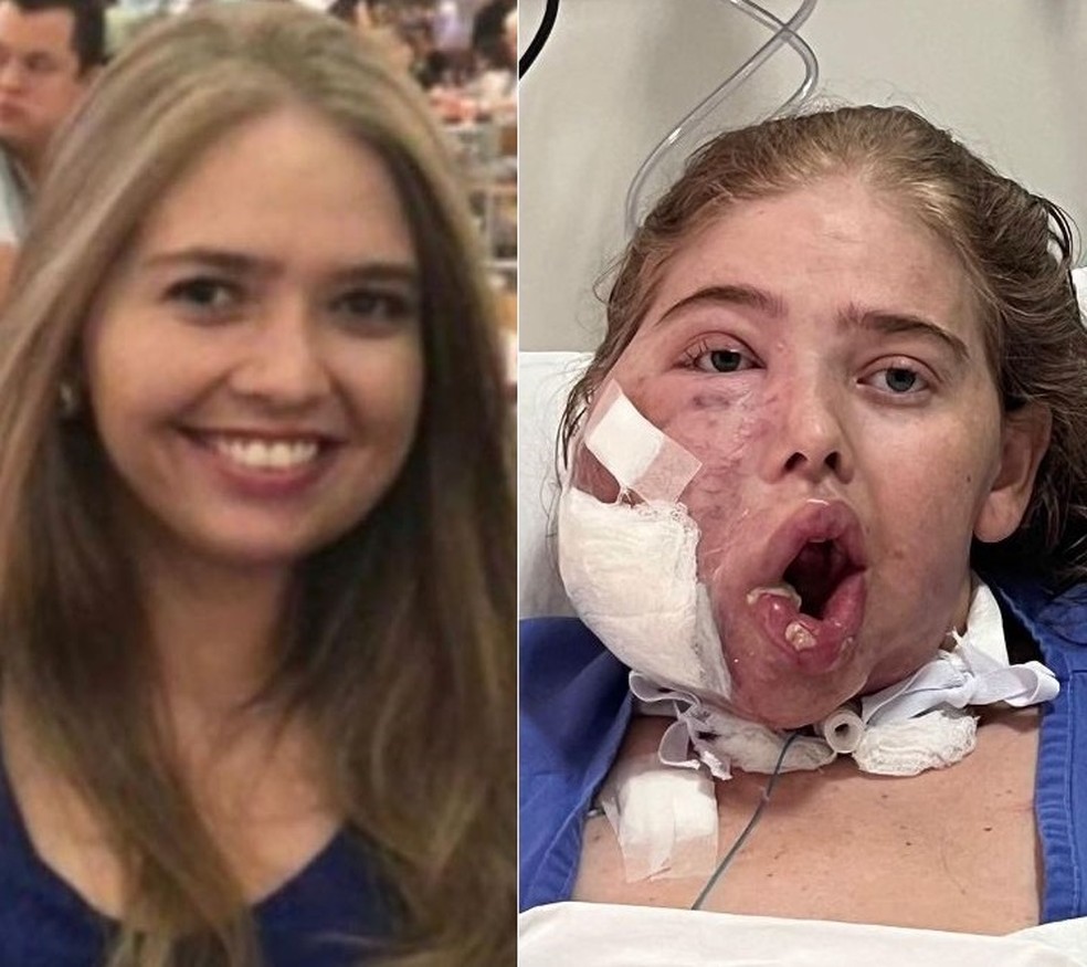 Jessica sofre com tumor que faz os vasos sanguíneos crescerem e se acumulare de forma excessiva — Foto: Divulgação