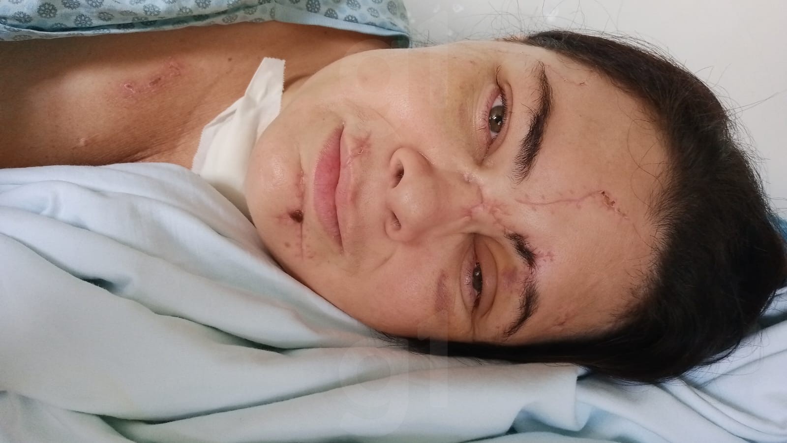 'Ouvi médicos dizer que eu não ia mais reagir', diz mulher que ficou em coma após agressão do ex