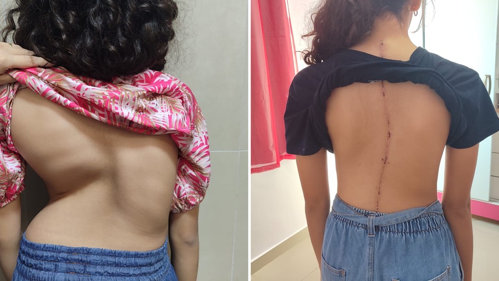 Curvatura na coluna de Bianca Furtado de Lima ultrapassou 100º; menina fez cirurgia em Rio Preto (SP) — Foto: Ana Flávia Furtado/Arquivo pessoal