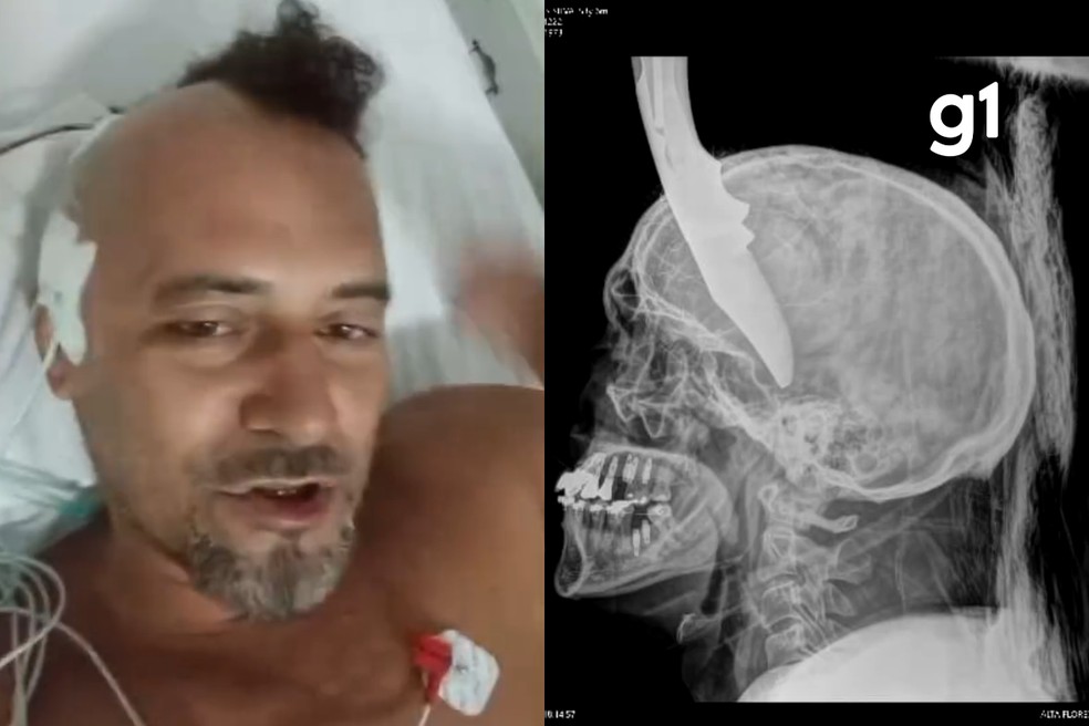 Eletricista teve canivete cravado na cabeça durante discussão com cunhado em MT — Foto: Reprodução