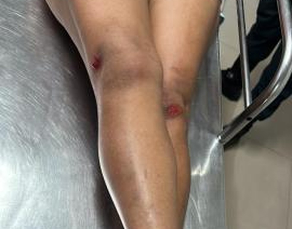 Vítima ficou com ferimentos no joelho e no rosto — Foto: PMRR/Divulgação