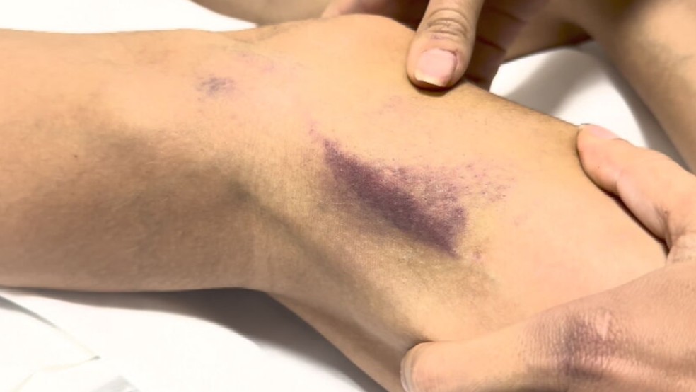 Mulher fica com hematomas após ser espancada pelo marido em Rio Preto (SP) — Foto: Reprodução/TV TEM