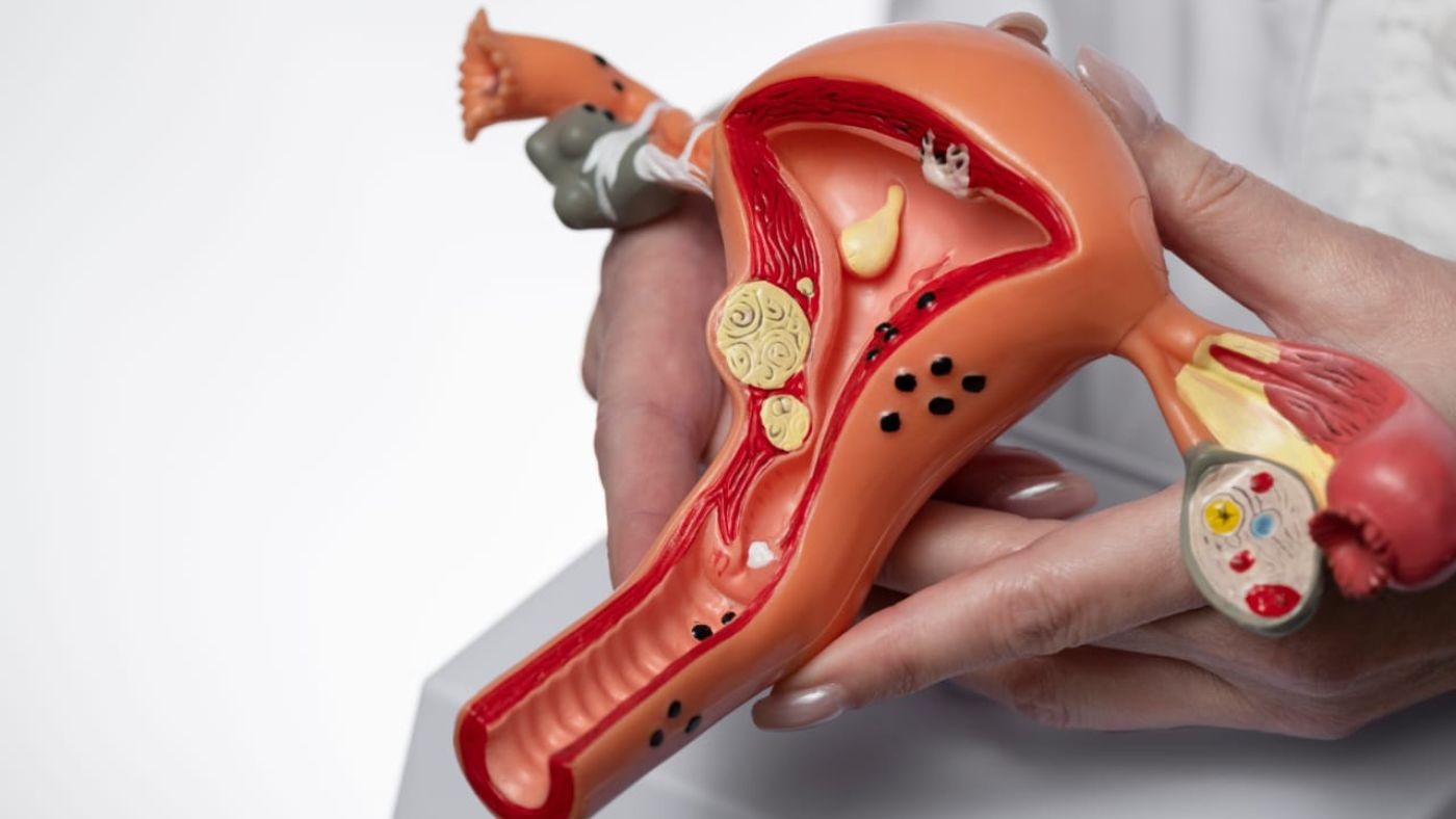 Endometriose Afeta Milhões de Mulheres e Pode Causar Dor e Infertilidade