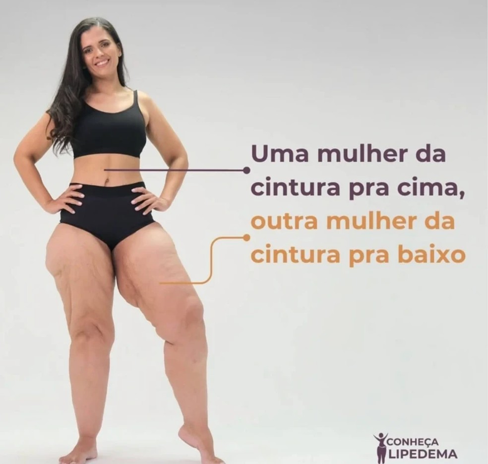 Paciente mostra a diferença causada pelo lipedema no formato de seu corpo em foto de campanha de conscientização da doença feita pela ONG Movimento Lipedema — Foto: Crédito: ONG Movimento Lipedema/Conheça Lipedema