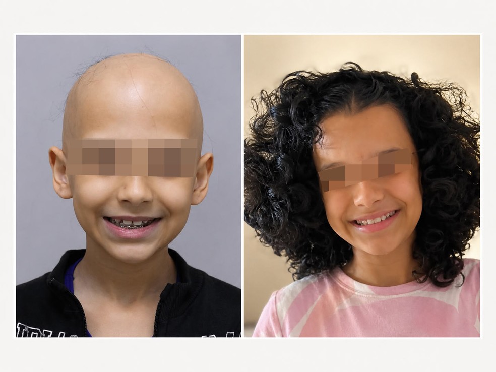 Maria Eduarda Miranda antes e depois do tratamento com ritlecitinibe para alopecia areata — Foto: Arquivo pessoal