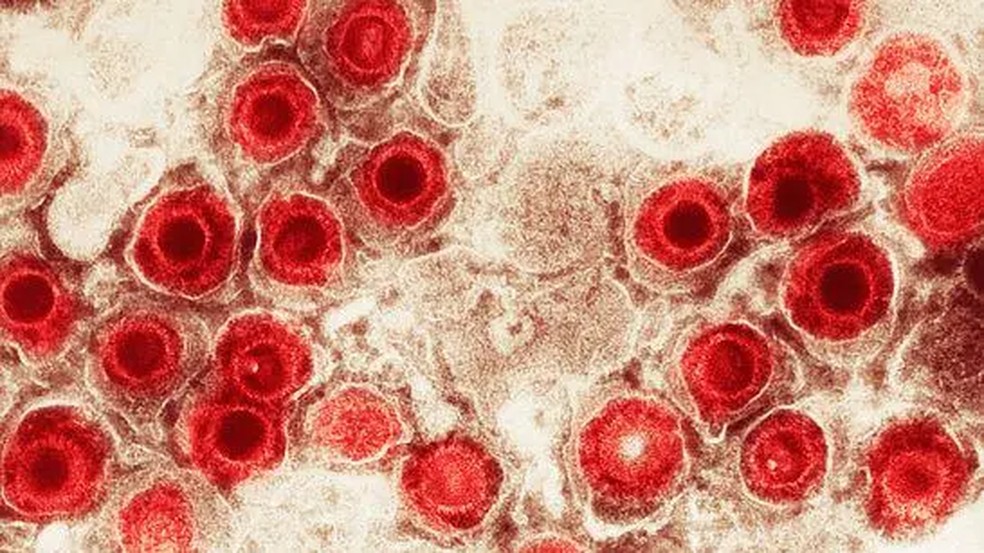 O herpes, que causa aquelas feridas no canto da boca e na região genital, fica dormente no corpo e pode ser um gatilho por trás do Alzheimer — Foto: Getty Images