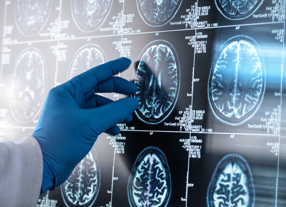 Demncia por corpos de Lewy  a segunda forma de demncia neurodegenerativa mais comum, depois do Alzheimer  Foto: Adobe Stock