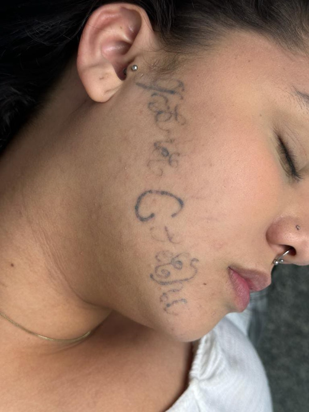 Rosto da Tayane atualmente, após seis sessões de laser para remoção da tatuagem. — Foto: Arquivo pessoal