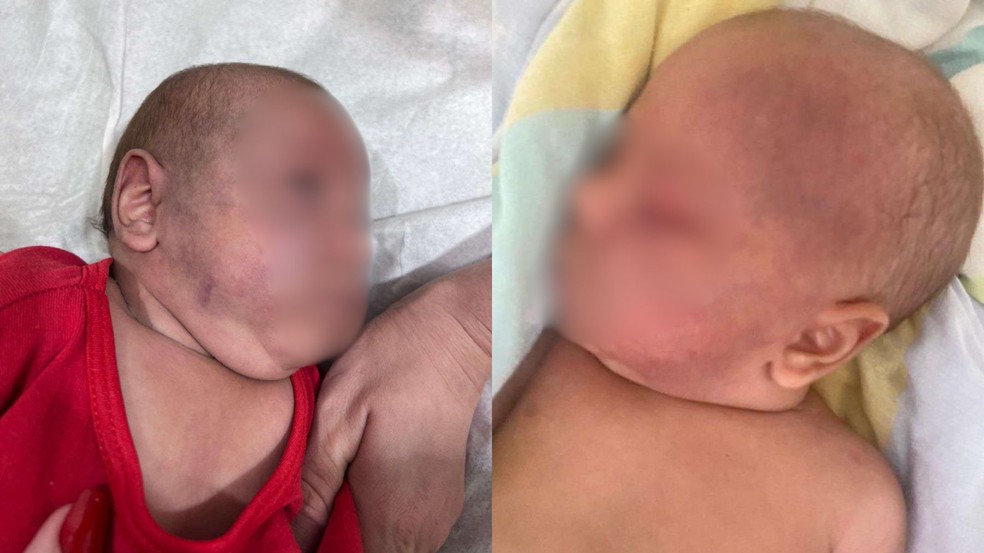 Beb&ecirc; apresentou v&aacute;rias les&otilde;es no rosto e no corpo &mdash; Foto: Minist&eacute;rio P&uacute;blico do Paran&aacute;