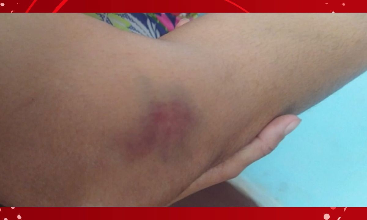 Mulher é agredida por ex-companheiro na Bahia; vítima tinha medida protetiva contra suspeito