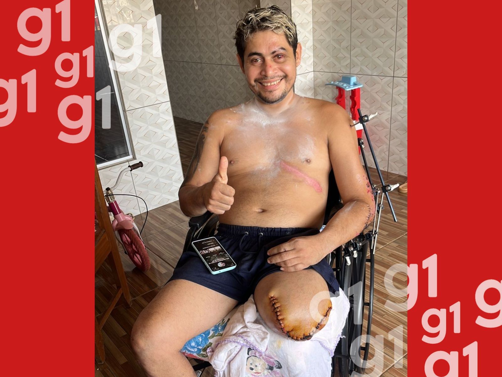 Motociclista que perdeu a perna após acidente passa por dificuldades financeiras no AC: 'Situação difícil'