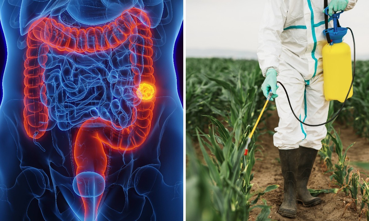 Estudo liga câncer colorretal em antes dos 50 anos à exposição a pesticidas e aponta herbicida como fator de risco