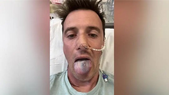 'Quase perdi a língua por um câncer e agora alerto outros homens sobre o risco do HPV'