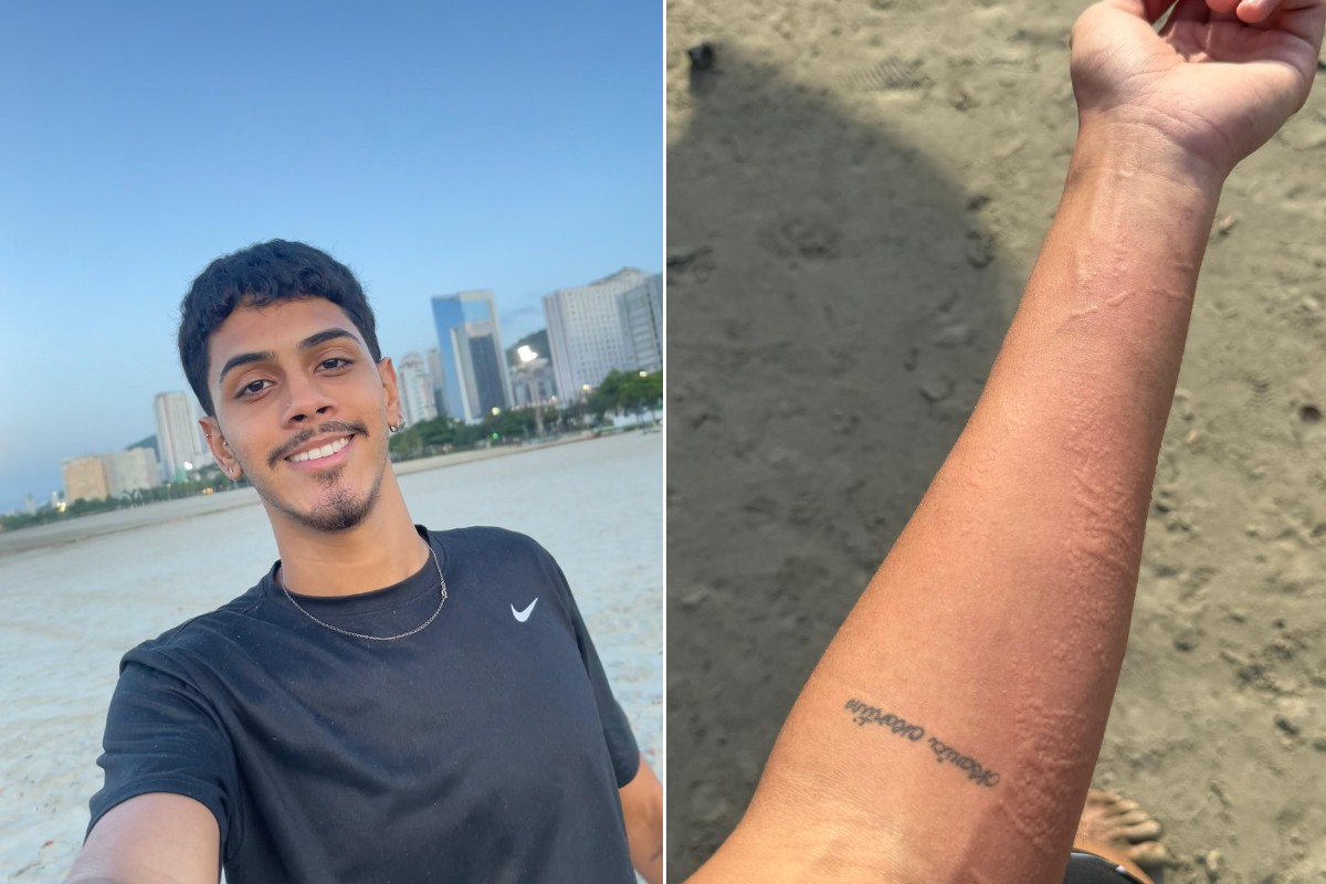 Jovem sofre queimadura de água viva no braço e quer tatuar animal após 'experiência única' no litoral de SP