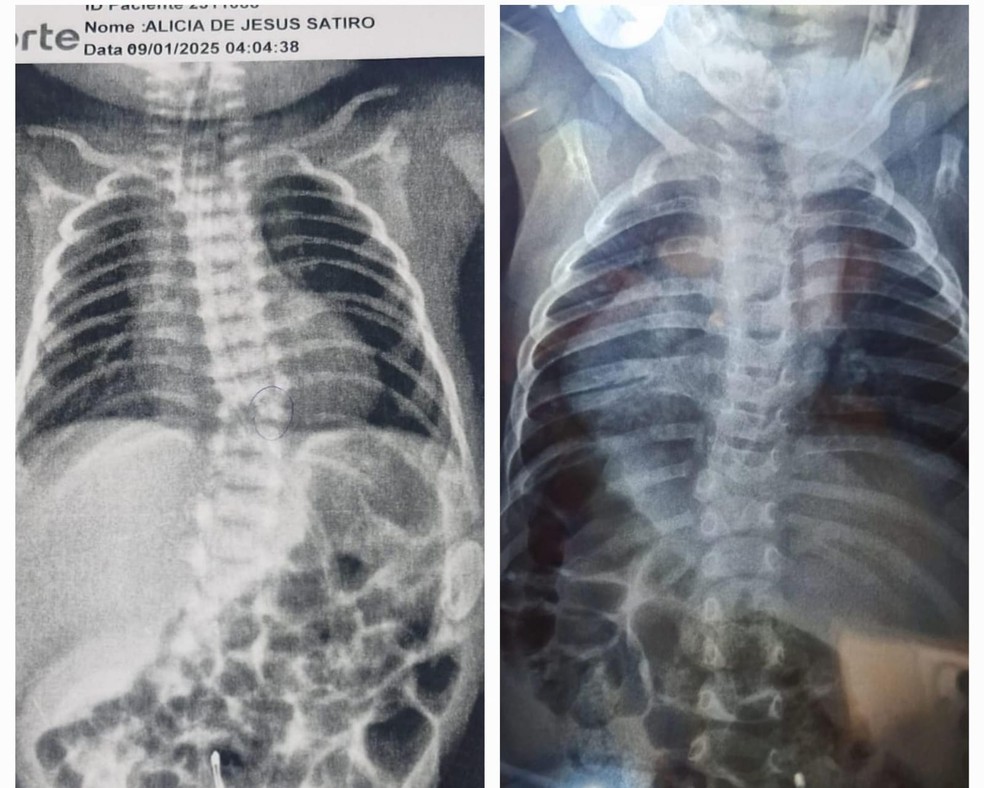 Escoliose antes e depois da fisioterapia em Alícia de Jesus Satiro — Foto: Arquivo Pessoal