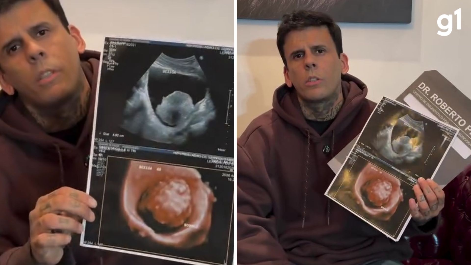 'Homem mais tatuado do Brasil' descobriu tumor momentos antes de sessão de remoção de tatuagens