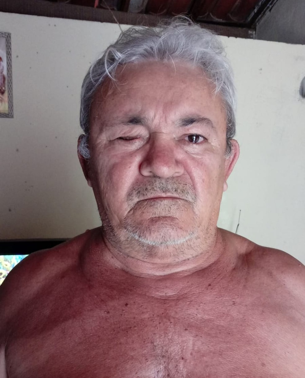 Francisco dos Santos, de 62 anos, foi uma das pessoas que perdeu o olho após passar por mutirão de cirurgia de catarata em Parelhas, RN — Foto: Cedida