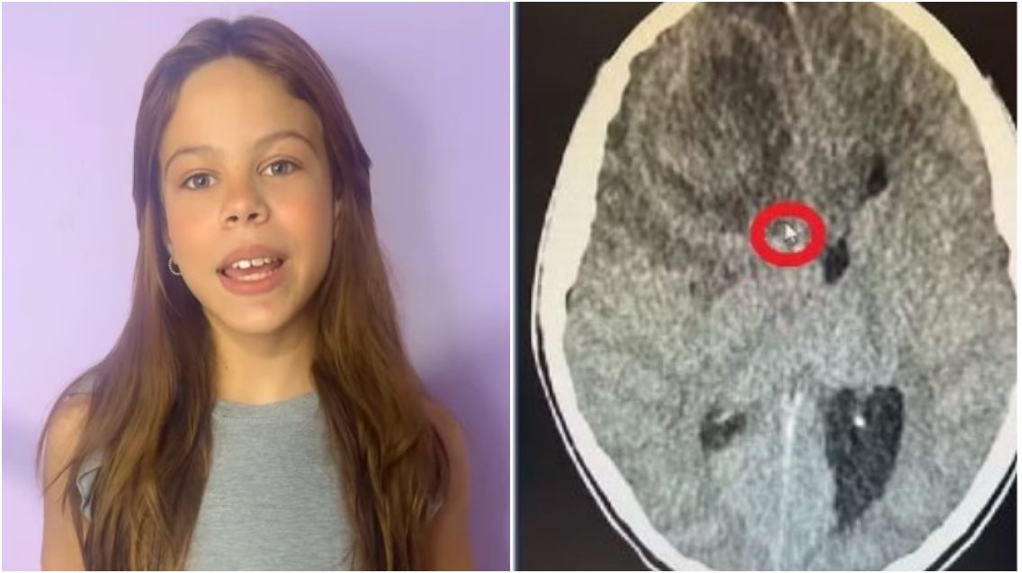Abscesso cerebral: entenda a condição que levou à morte da atriz mirim Millena Brandão